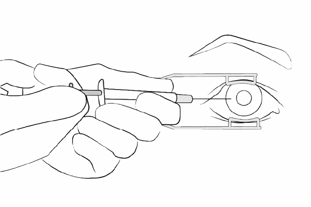 Illustration of the current procedure for collecting ocular fluid using a syringe and both hands